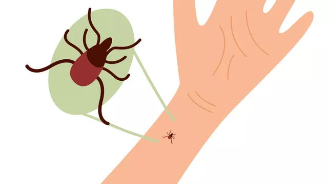 Что делать при укусе клеща и как предупредить вирусный энцефалит. Объясняет врач